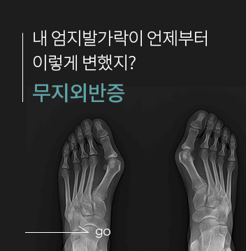 무지외반증